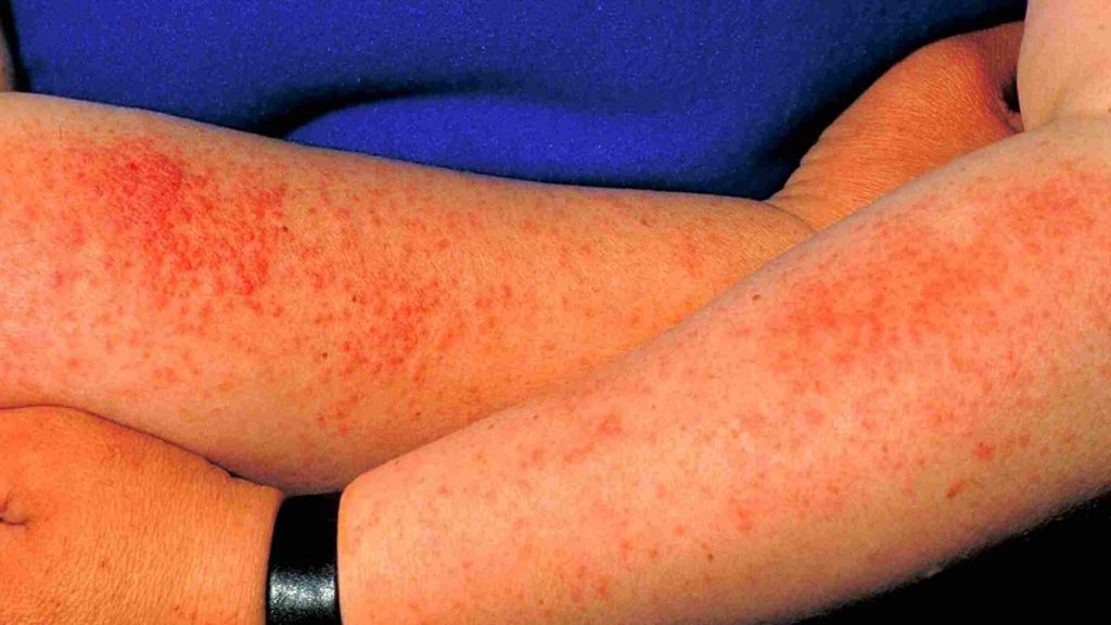 What Does Sun Allergy Rash Look Like Pictures of sun allergy rash