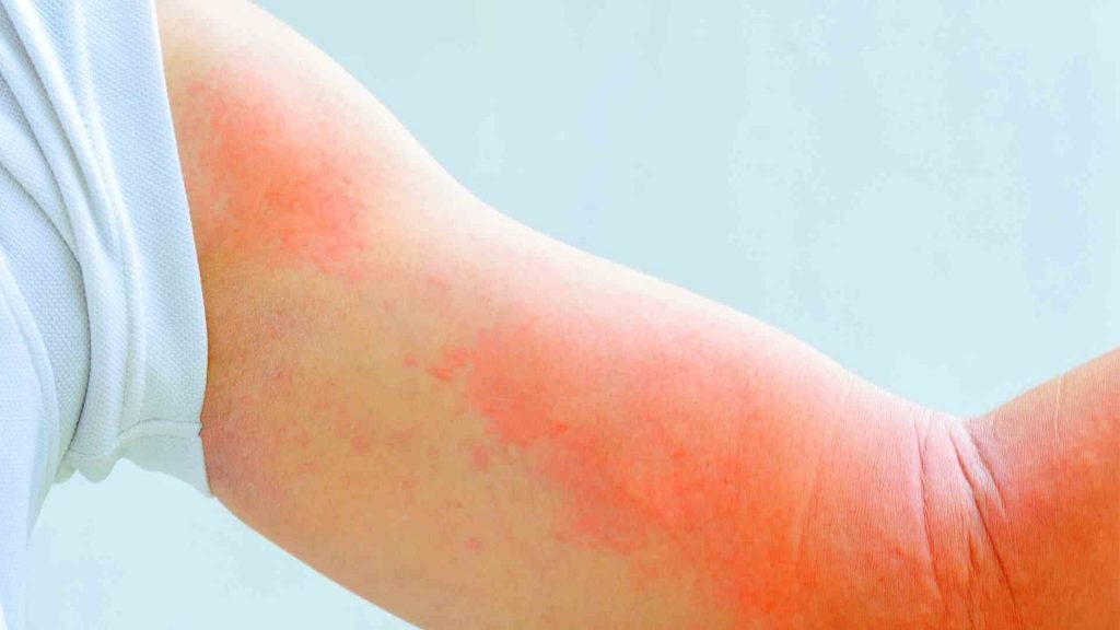 What Does Sun Allergy Rash Look Like Pictures of sun allergy rash
