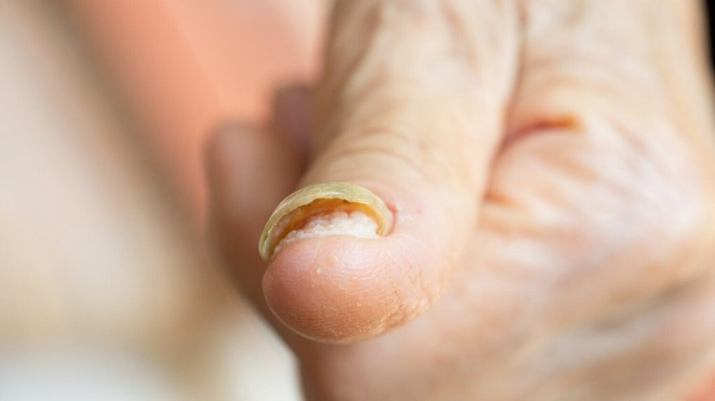 fungal nail pain and infection